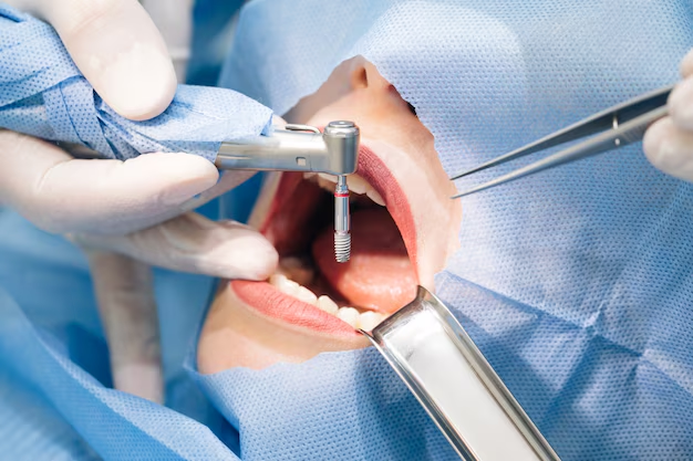 Implantes Dentales
